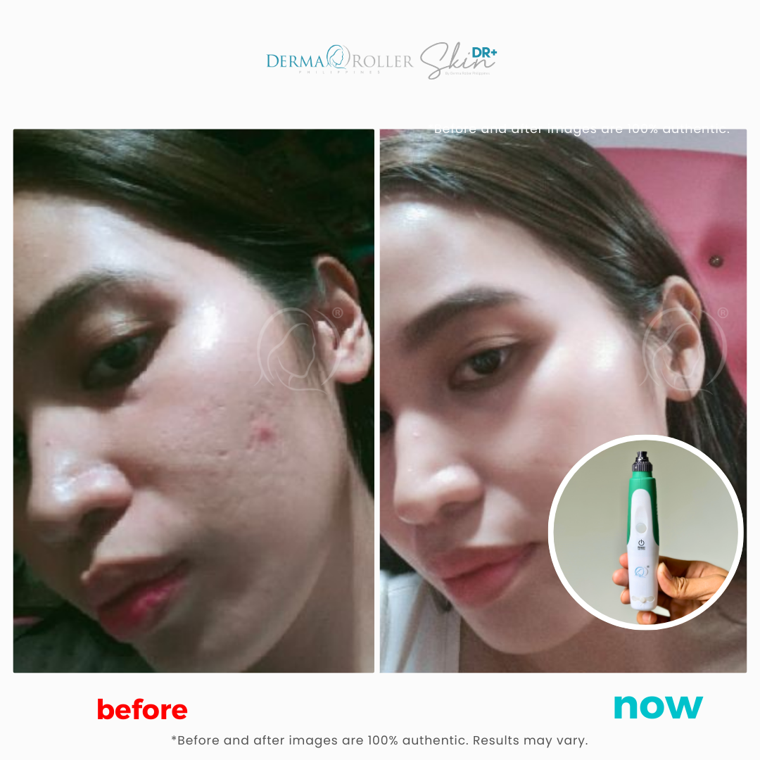 Derma Pen™ [PRE-ORDER]