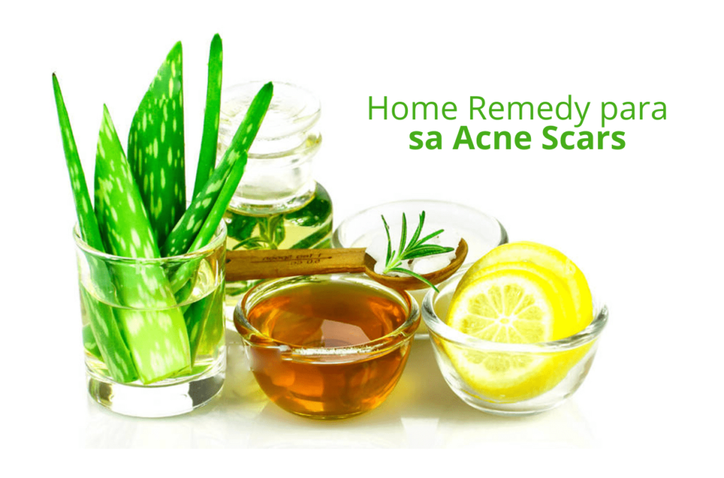 home remedy for acne scars
